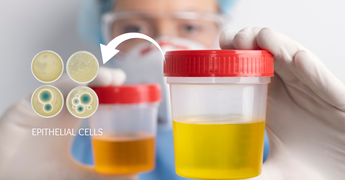 Epithelial Cells in Urine
